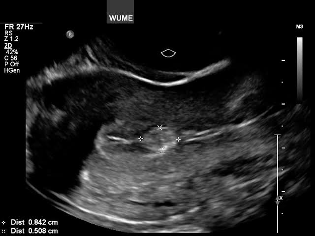 Gynaecological ultrasound
