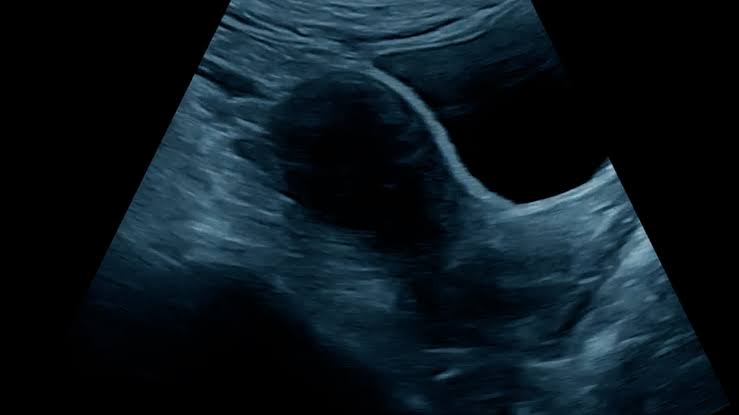 Pelvic ultrasound