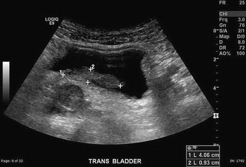 Transabdominopelvic ultrasound