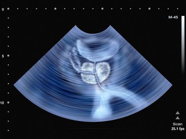 Transrectal ultrasound